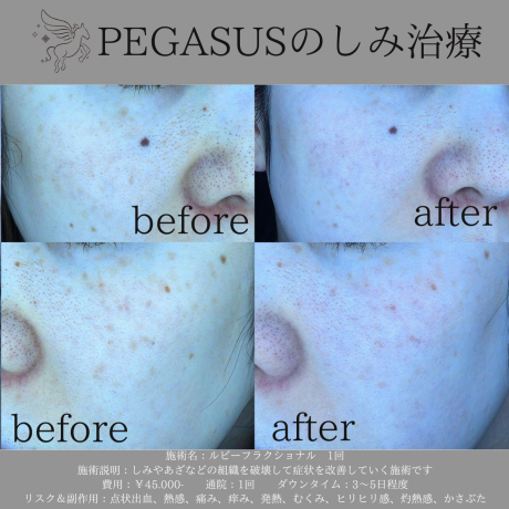 ルビーフラクショナル1回でどう変わる！？ | 美容皮膚科