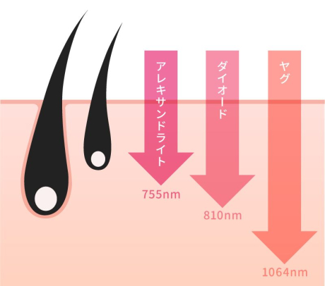 医療脱毛♡波長の違いについて | 美容皮膚科