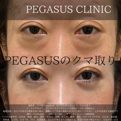 クマ取りで疲れ顔を解消💡 | 美容外科