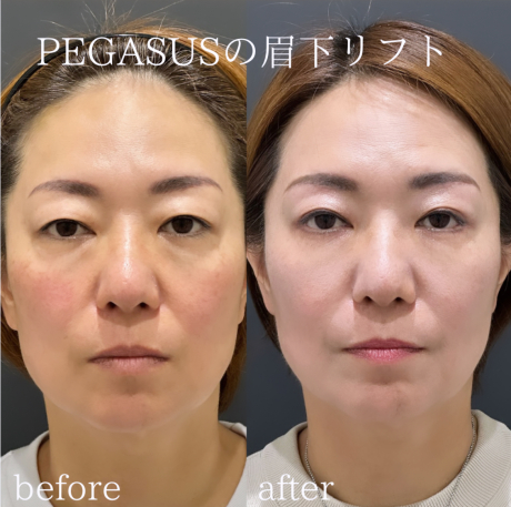 No.3眉下リフト・Roof切除・クマ取りbasic CRF目の下〜ゴルゴ+表ハムラ変更・CRF法令線 | 美容外科