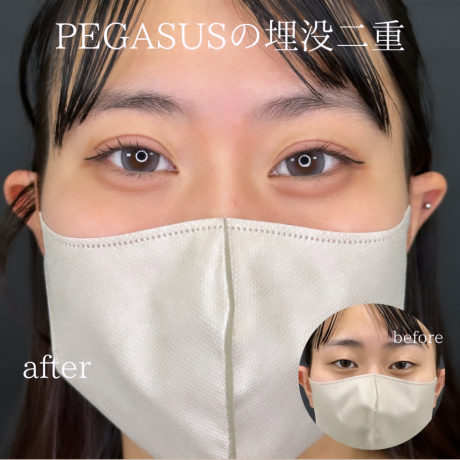 No.54埋没二重premiumトリプルループ裏留め | 美容外科