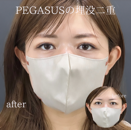 No.55埋没二重premiumトリプルループ裏留め+ヒアルロン酸0.3CC涙袋 | 美容外科