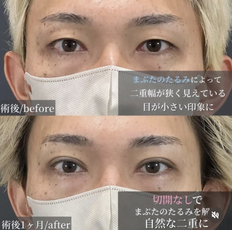 男性必見！メンズ二重の症例がこちら！ | 美容外科