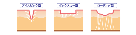 ピコフラクショナルでクレーター撃退! | 美容皮膚科