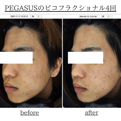 クレーター治療ってほんとに治るの？？？ | 美容皮膚科
