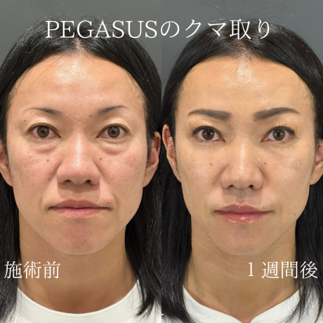クマ取り+脂肪注入 | 美容外科