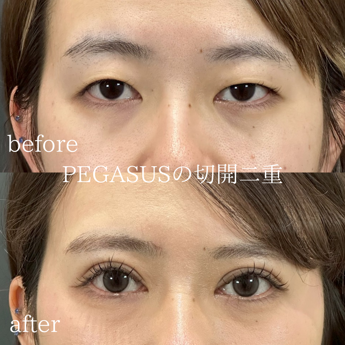 切開二重＋眼瞼下垂＋目頭切開 | 美容外科