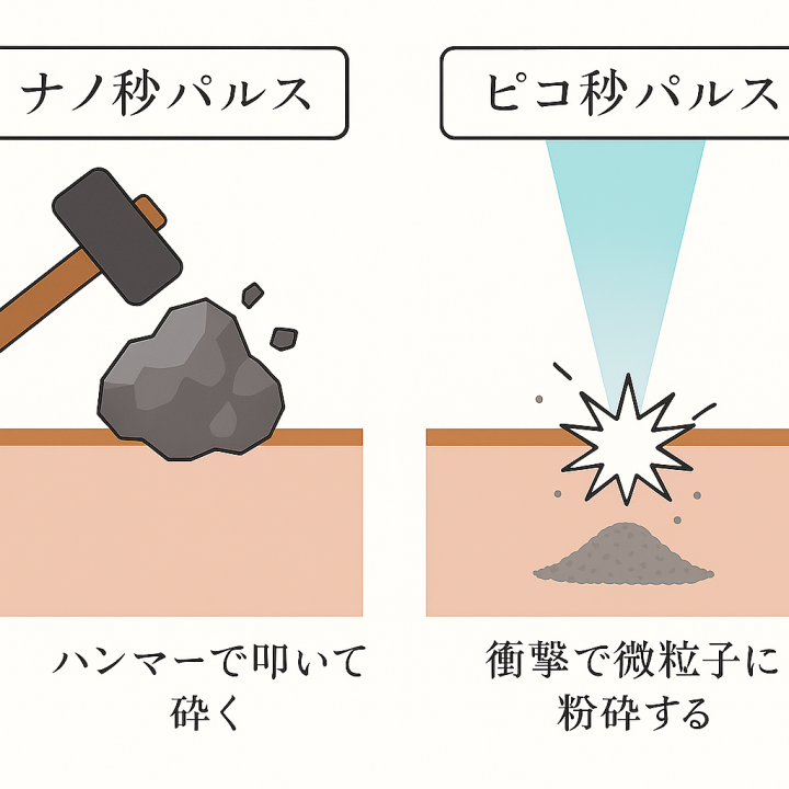★ピコレーザーの特徴