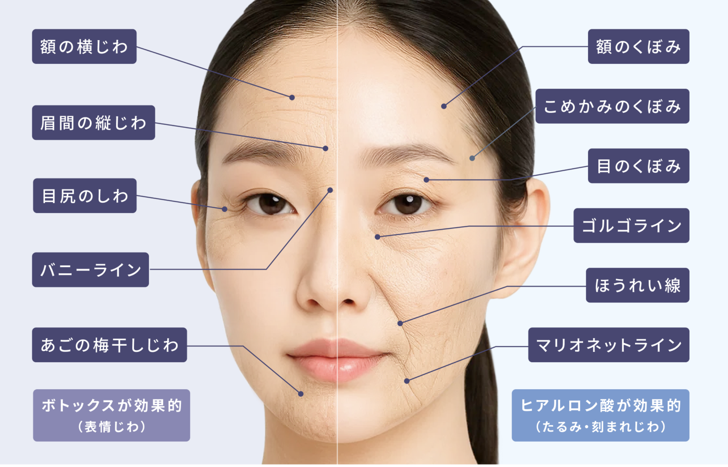 院長が教える】「ボトックスorヒアルロン酸」の違い、正しく理解できてる？シワ改善の, image size:2474x1588